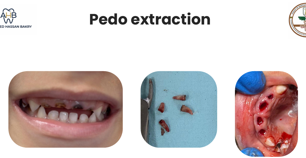 Pedo extraction